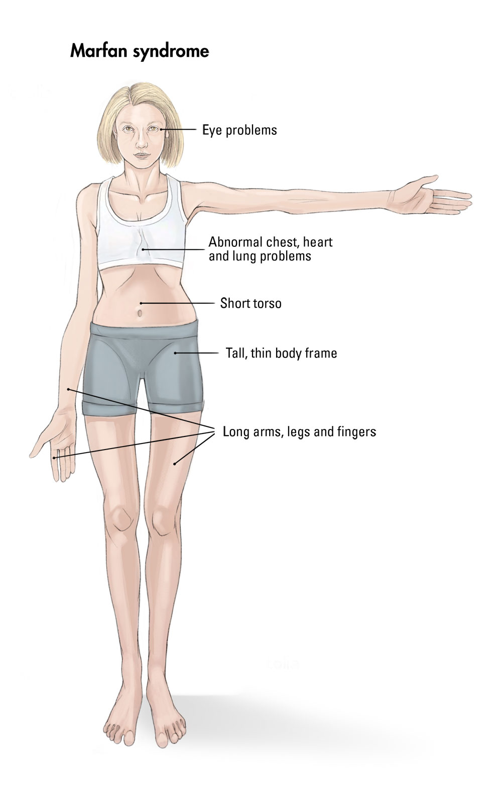 Marfan Syndrome Marfan Syndrome